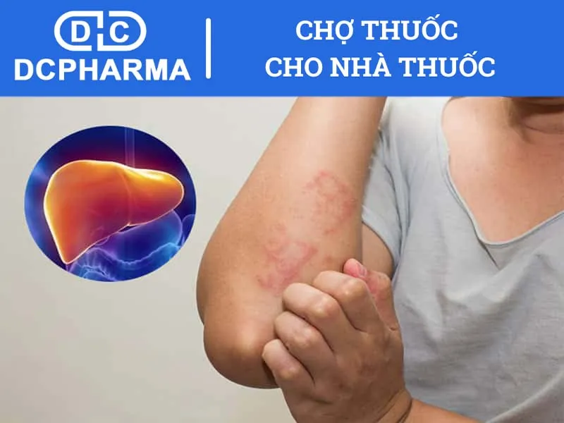 Biểu hiện của bệnh nóng gan