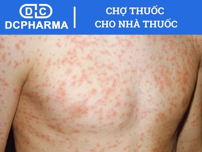 thuốc chữa dạ dày omeprazol