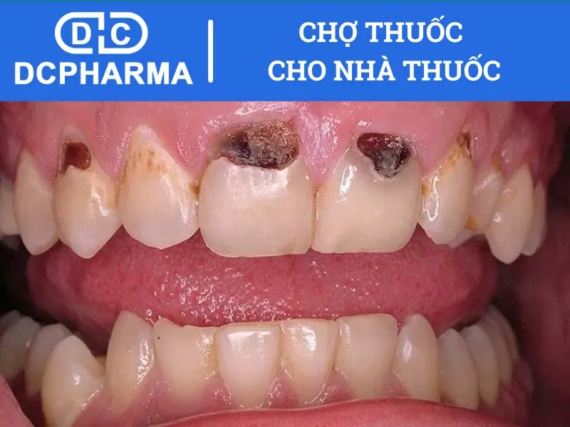 thuoc diet tuy rang la gi khi nao nen dat thuoc 67569d371ed45