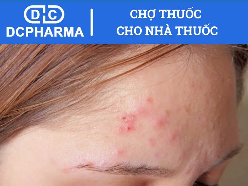 Công dụng của thuốc Momate-S