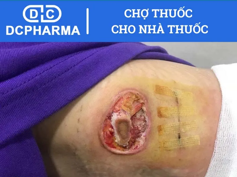 Trường hợp không sử dụng thuốc bôi nhiễm khuẩn da Momate-S