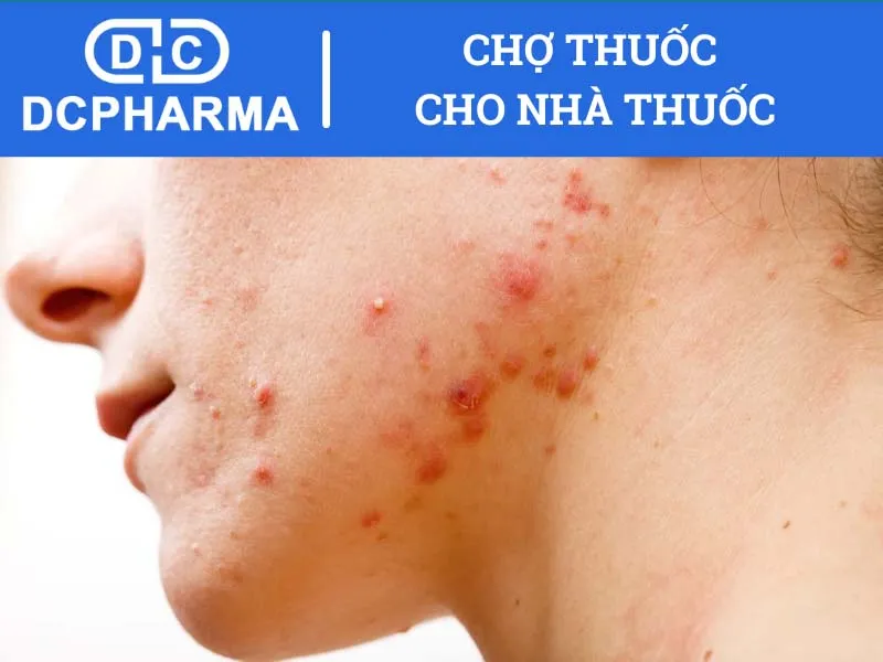 Tác dụng phụ của thuốc viêm da dị ứng Momate-S