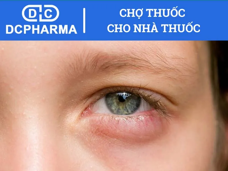 Tác dụng phụ thuốc nhỏ mắt optive