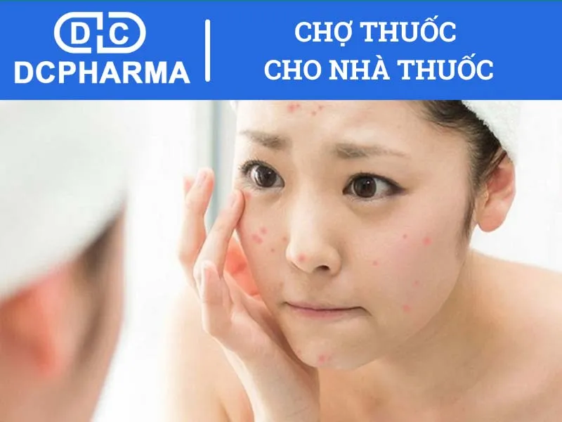 Các tiêu chí giúp chọn được loại thuốc trị mụn phù hợp