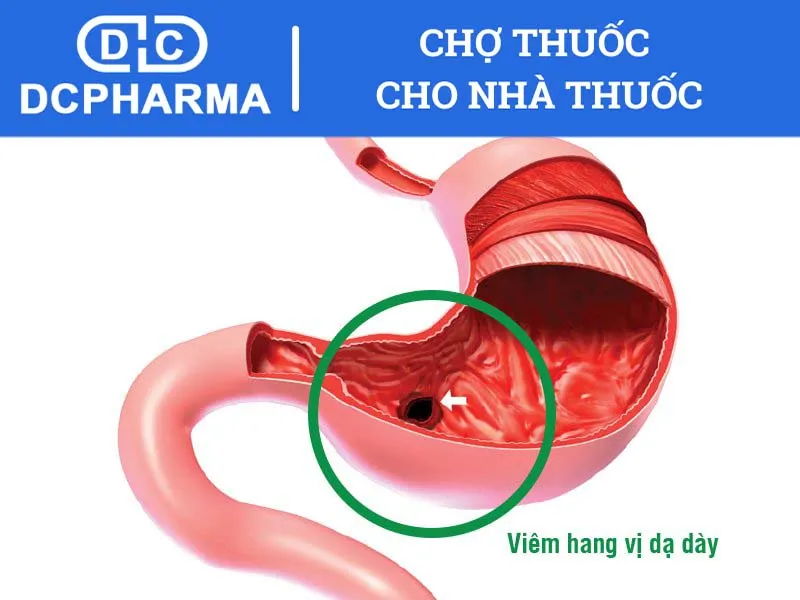 viêm hang vị dạ dày là gì